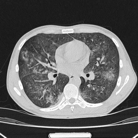 Pneumocystis Jiroveci Pneumonia