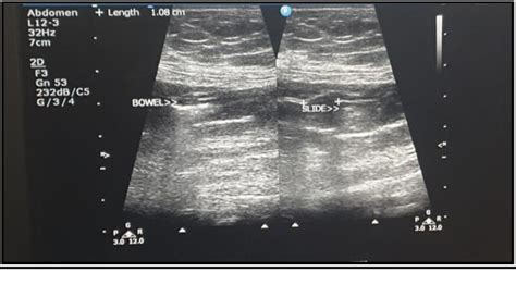 Figure 1 From Evaluation Of Intra Abdominal Adhesion Formation After