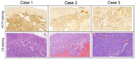 Histopathology Of The Adrenal Tumors Magnification The Upper