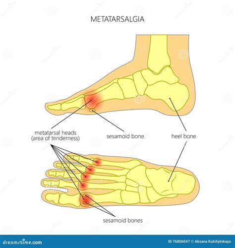 Metatarsal Bone Anatomy