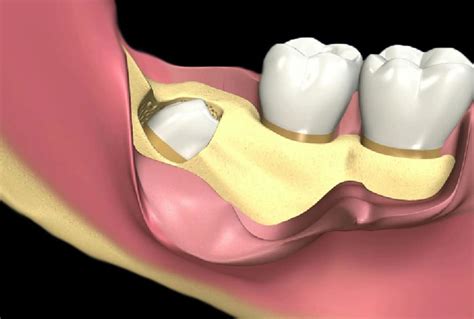 Estrazioni Denti Del Giudizio Dentista Mb Lugano