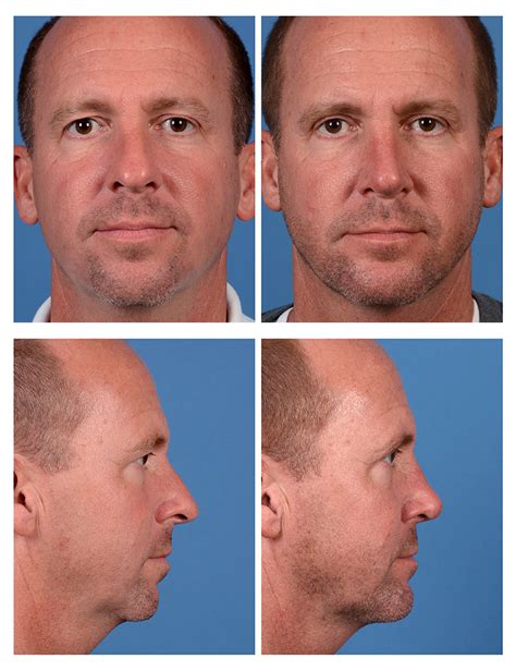 Male Rhinoplasty Before And After Photos