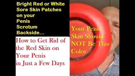 Red Penis How To Get Rid Of Redness On Foreskin Gland And Shaft Youtube