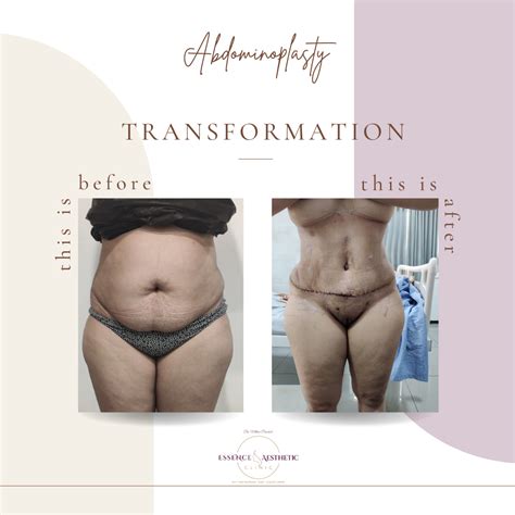 Abdominoplasty Essence Aesthetic