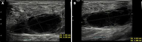 Groin Hematoma Ultrasound