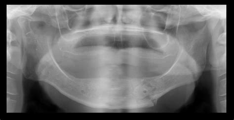 Caso Nº 378 FRACTURA MANDIBULAR CDI Perú