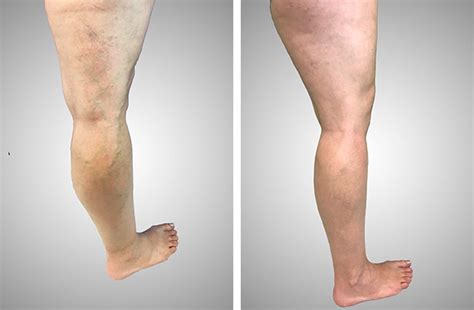 See Before After Photos At Gallery Boston Vein Care