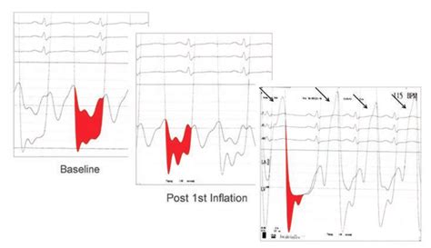 A Brief Review Of Hemodynamics For Structural Interventions Part 2