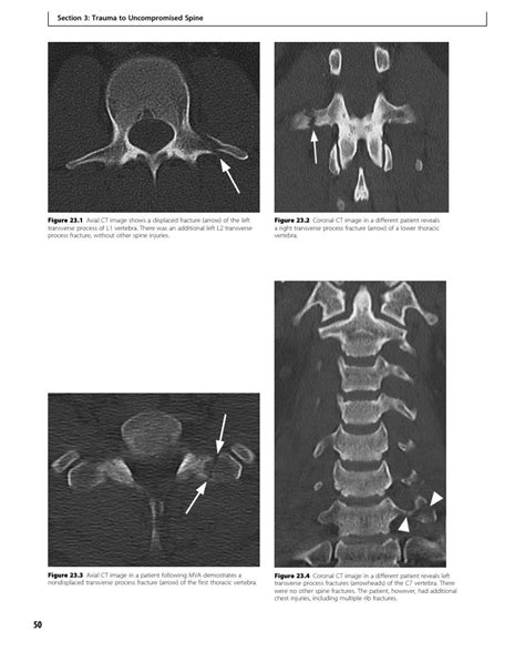 Isolated Transverse Process Fracture Case 23 Clinical Imaging Of Spinal Trauma