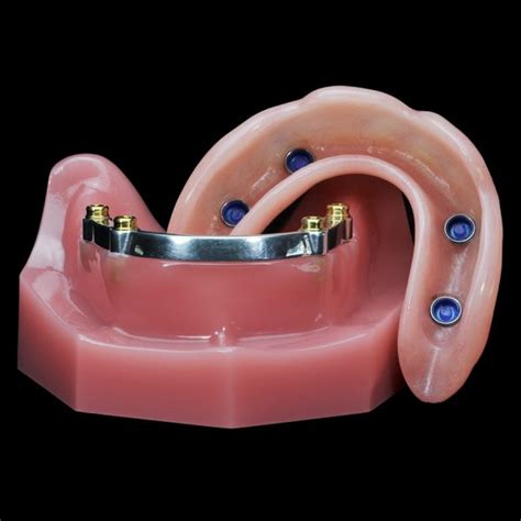 IM-01 Locator Overdenture | Paradigm Dental Models