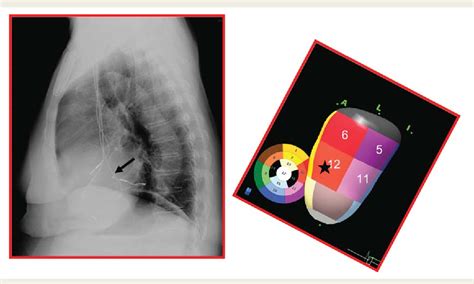 Figure 2 From Comparison Of Quick Optimization Of Interventricular