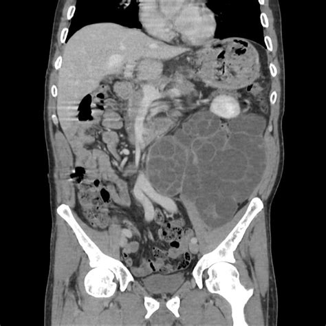 Retroperitoneal Hydatid Cyst Image Radiopaedia Org