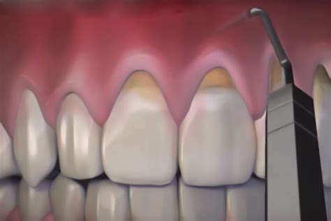 Pinhole Surgical Technique® Monroe Ct Gum Recession