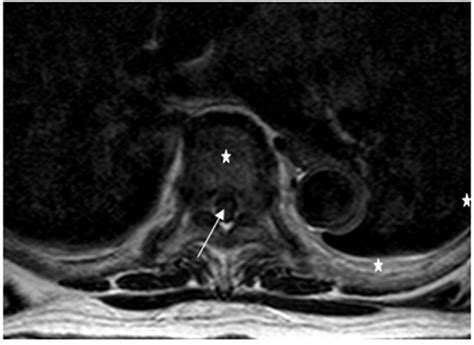 Figure 1C MRI Thoracic Spine Axial T2 T6 Vertebral Body Arrow