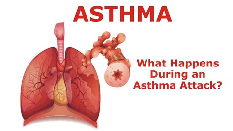 Asthma What Happens During An Asthma Attack Youtube