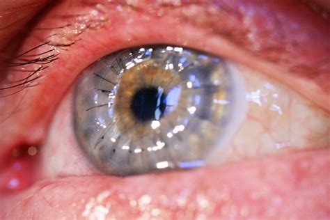 transplantasi kornea teknik indikasi komplikasi pedoman klinis