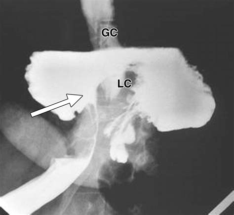 Volvulus Of The Gastrointestinal Tract Appearances At Multimodality