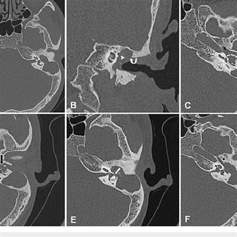 Hrct Signs Of Csom And Cholesteatoma In Diseased Temporal Bones