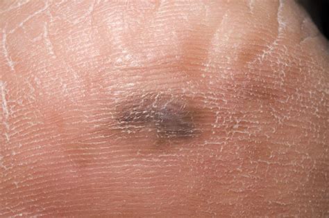 Signs Of Skin Cancer Spots