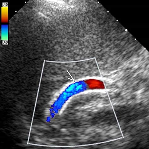 Transjugular Intrahepatic Portosystemic Shunt Tips Radiology Key