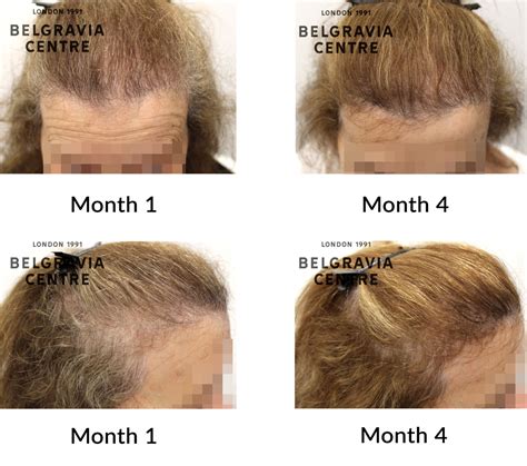 Hair Loss Success Story Very Amazed And Happy To See The Results