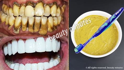 Teeth Whitening At Home In 3 Minutes How To Whiten Your Yellow Teeth Naturally 100 Effective