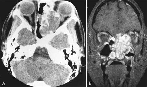 Tumors Of The Ear And Temporal Bone Obgyn Key