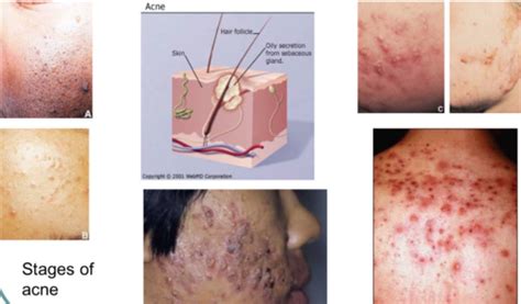 Pance Prep Pearls Derm Acneiform Lesions Flashcards Quizlet