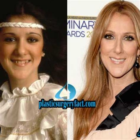 Celine Dion Plastic Surgery Photos Before After