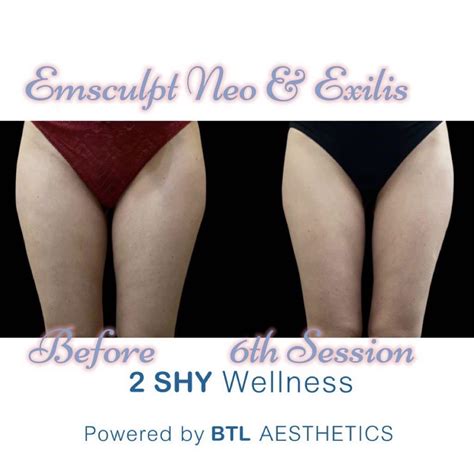 Jun Promo Authentic Emsculpt Neo Only Fda Hsa Approved Muscle