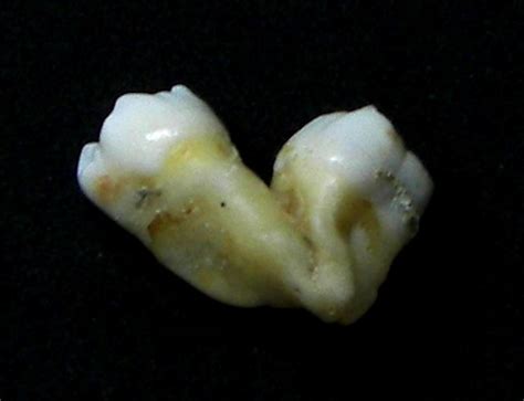 Deformutilation: Concrescence - Tooth Fusion