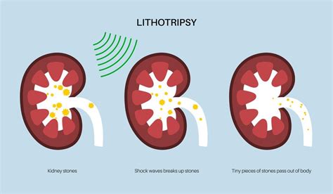 Premium Vector | Lithotripsy procedure concept