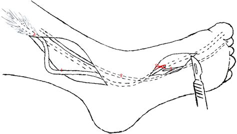 Double-incision technique (1). FHL tendon, (2). FDL tendon, (3).... | Download Scientific Diagram