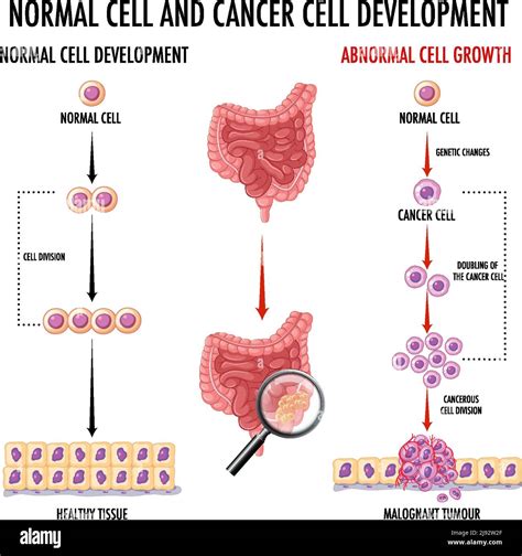 Diagrama que muestra las células normales y cancerosas en la