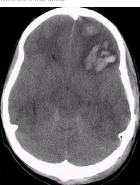 Figure 4 From Use Of Transcranial Cerebral Oximeter As Indicator For Bifrontal Decompressive