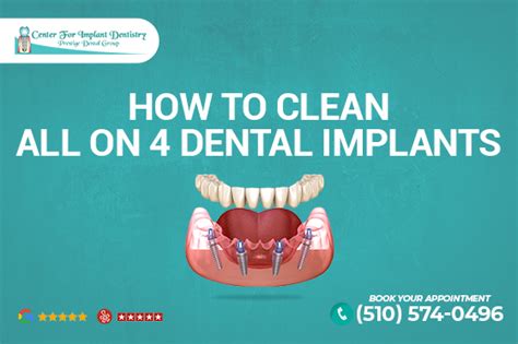 How To Clean All On Dental Implants Center For Implant Dentistry