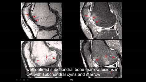 Mri Imaging Of Knee Part 2 By Dr Amr Saadawy Youtube