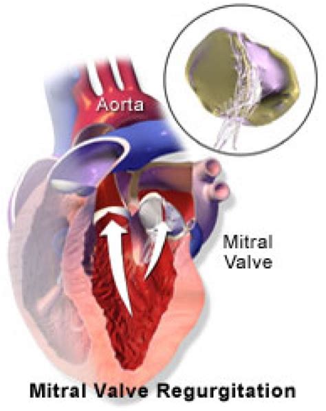 What Is Mitral Valve Prolapse Hubpages