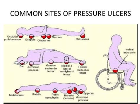 Diagram Foot Diagram Pressure Ulcer Wiringschemacom