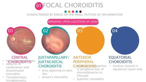 Posterior Uveitis Ppt