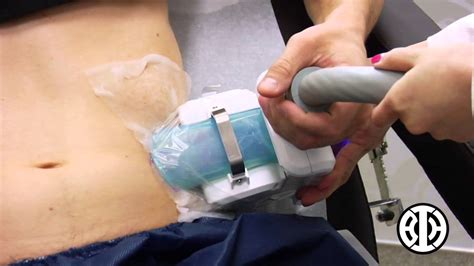 Coolsculpting To Treat Men S Love Handles Youtube