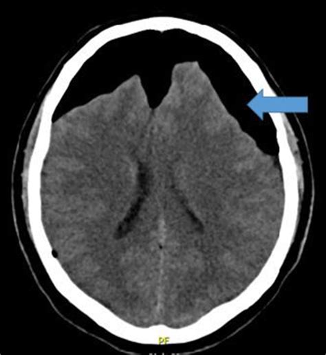 A compression bifrontal, supra, and infratentorial pneumocephalus | Download Scientific Diagram