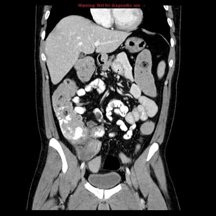 Mucinous Carcinoma Of The Colon Radiology Reference Article