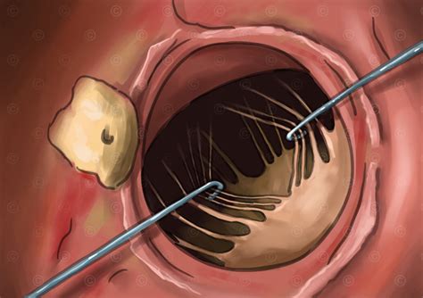 Illustration Mitral Valve Insufficiency Alfieri Stitch MedicalGraphics