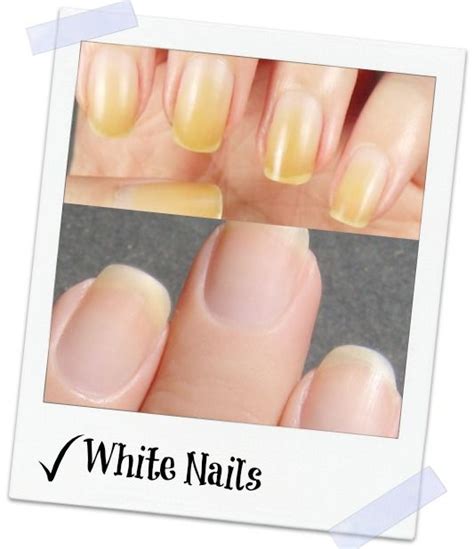 The Yellowing Of Your Nails Is A Problem That Occurs Quite Frequently