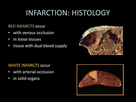 Ppt Embolism And Infarction Powerpoint Presentation Free Download