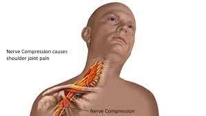 Brachial Plexopathy - EMG NCV