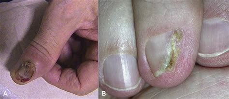 The Detection Of Human Papillomavirus In Squamous Cell Carcinoma Of