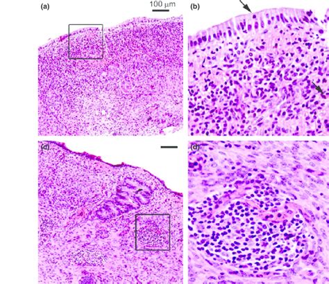 Inflammation Of The Endometrium Photomicrographs Of Haematoxylin And