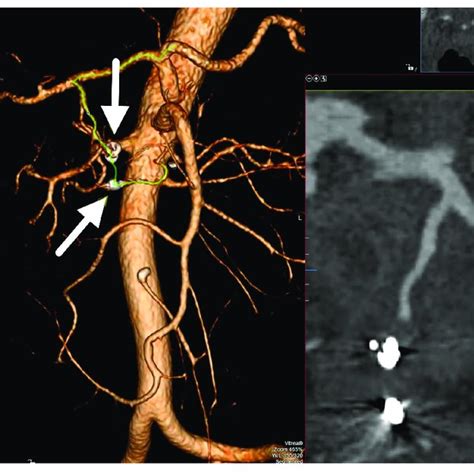 D Volume Rendering Ct Image Shows The Complete Exclusion Of The